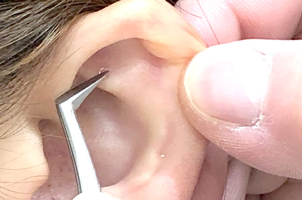 耳ツボダイエット